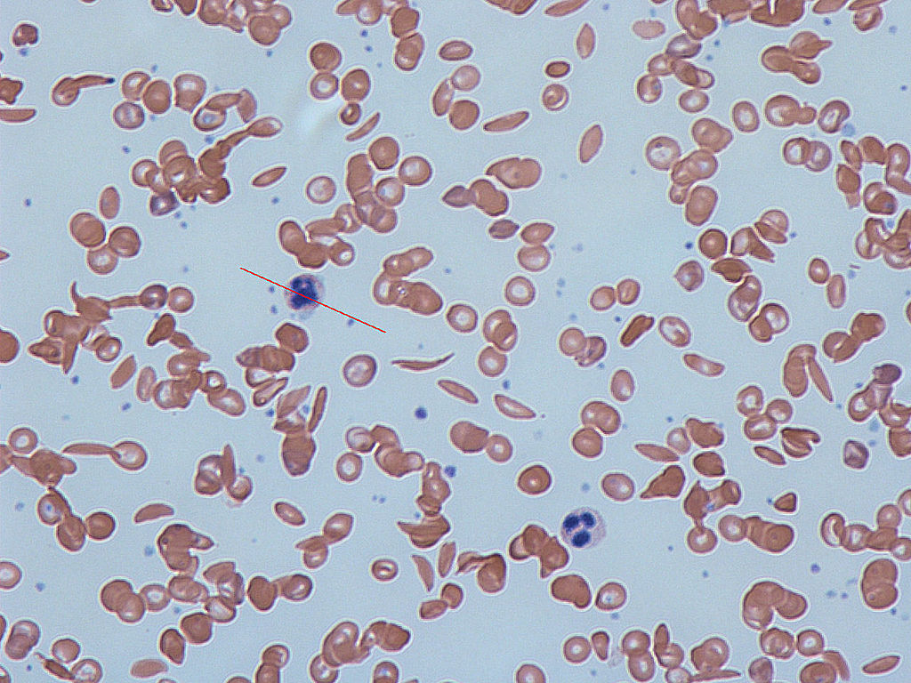 image of sickle cells