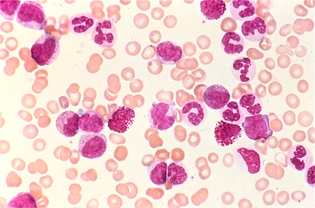 Overlapping Blood Smear.