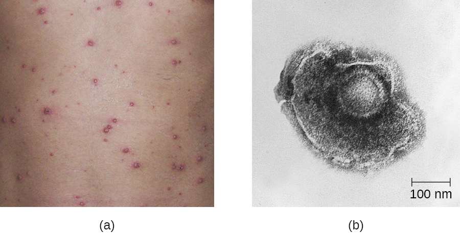a) red bumps on skin. b) a micrograph of human herpesvirus 3 is shown. The diameter is approximately 300 nanometers according to a scale bar on the bottom right of the micrograph.